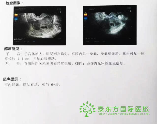4次流产内膜薄难怀孕 泰国试管一次便成功